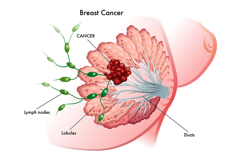 Recognizing Early Signs Of Breast Cancer In Seniors